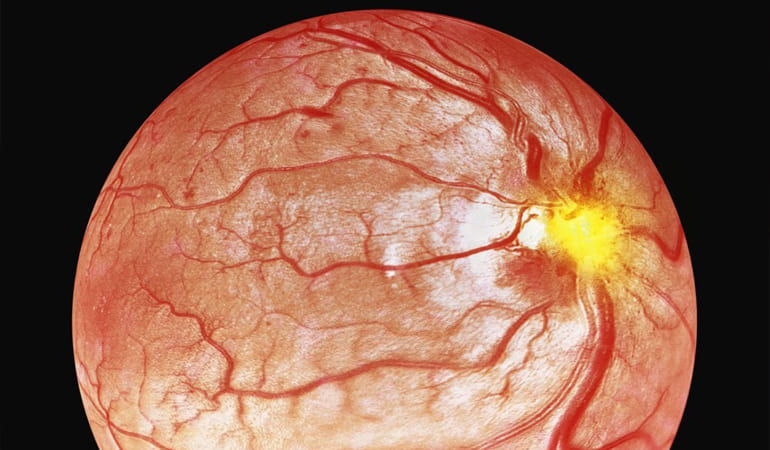 Tomografía de coherencia óptica del nervio óptico y la macula